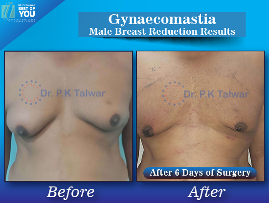 Gynaecomastia before after image